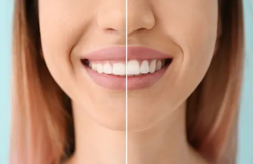 Laser Gum Contouring - For a Bigger and Brighter Smile