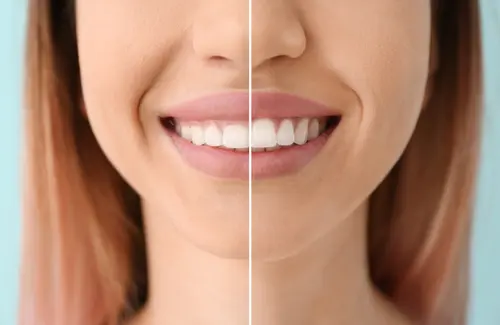 Laser Gum Contouring 