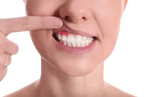 Pinhole Gum Treatment 
