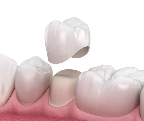 Porcelain Crowns - Natural Smiles KY