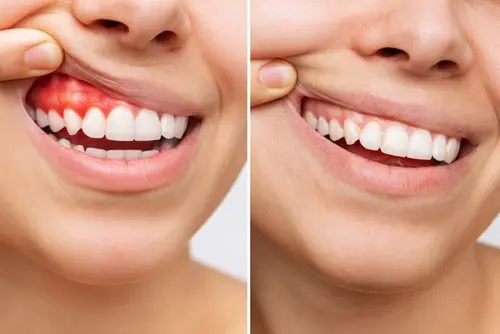 Gum Disease - Natural Smiles KY